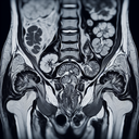 МРТ малого тазу у жінок