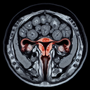 МРТ матки шийки матки